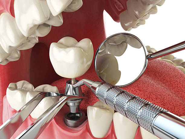 Best Emergency Dentist for Knocked-Out Tooth in World Golf Village, FL